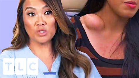 The Contents Of This Huge Bump Surprises Dr Lee Dr Pimple Popper Youtube