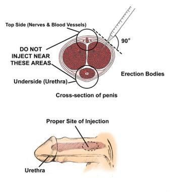 Forced Cock Injection BDSM Fetish