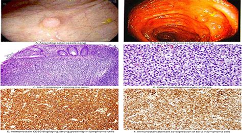 S1838 Malt Lymphoma Of The Colon A Case Series Of A Rare Di