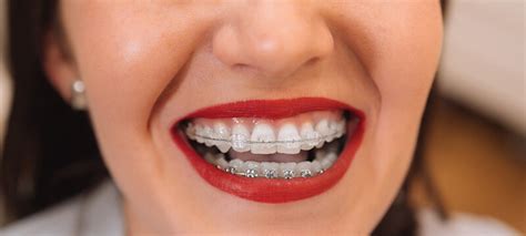 Brace Yourself For The Perfect Smile How Braces Work Hamburg Dental Care