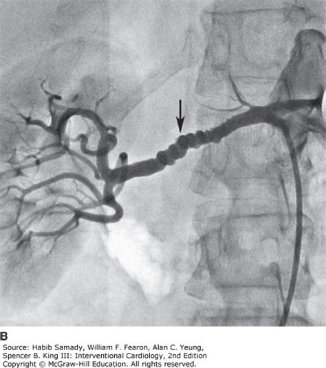 Renal Artery Angioplasty And Stenting Thoracic Key