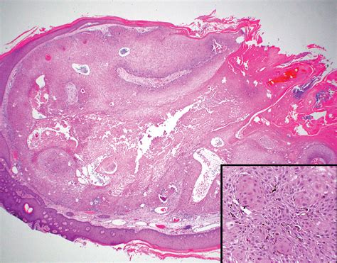 Ulcerated Nodule On The Scalp Mdedge Dermatology