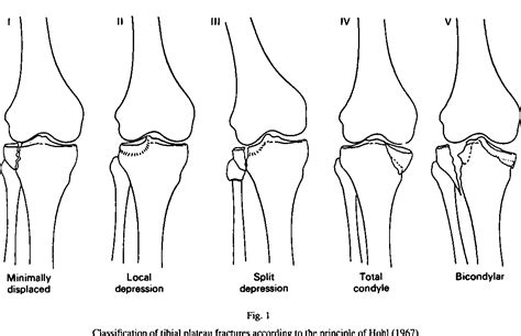 Tibial Plateau Fracture Classification Moore