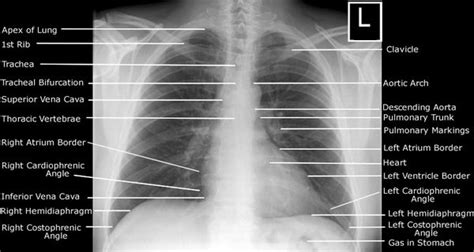 Systematic Approach To Frontal Chest X Ray Epomedicine