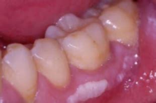 White Spot On Gums Causes Pictures Painful Above Tooth Under Tooth