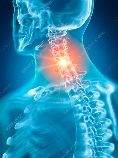 Illustration Of A Painful Cervical Spine Stock Image F0238473