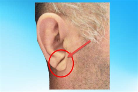 Does A Crease In The Ear Lobe Mean Heart Problems Universal College