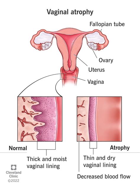 Vaginal Atrophy Causes Symptoms Diagnosis And Treatment