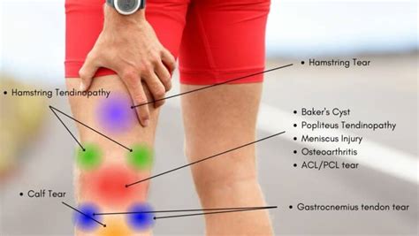 Knee Pain Location Chart Learn The Pain Location Of Knee Injuries