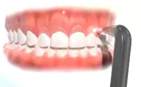 Gingivectomía ¿qué Es Clínica Dental En Valencia Benimaclet