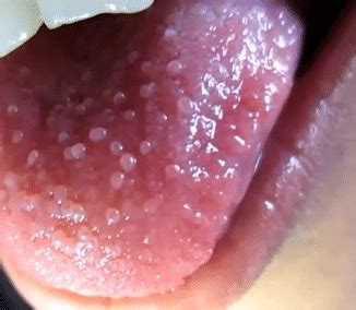 This swelling can cause on any one side of the tongue or cheek, soft palate and other parts of the mouth. Swollen Taste Buds (Inflamed), On Back of Tongue, Sides ...