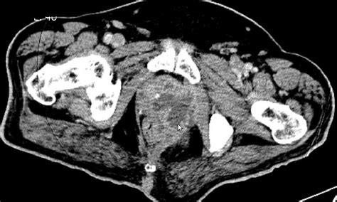 Ct Image Of Perianal Abscess Based From Prostatic Abscess Download