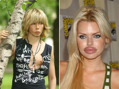 Plastic Surgery Gone Wrong 17 Pics
