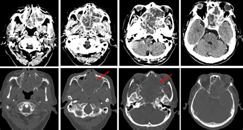 Adenoid Cystic Carcinoma Of Ethmoidal Sinus Radiology Cases