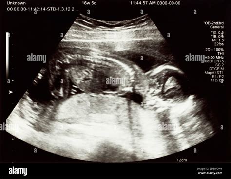ecografia fetal fotografías e imágenes de alta resolución página 2 alamy