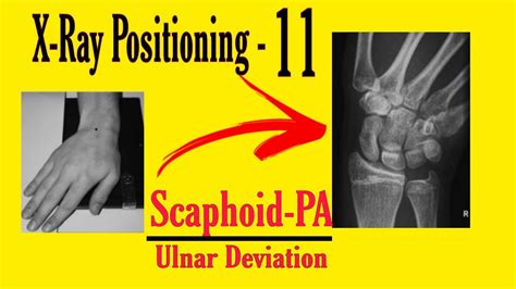 Scaphoid Pa X Ray Positioning Ulnar Deviation X Ray Positioning For