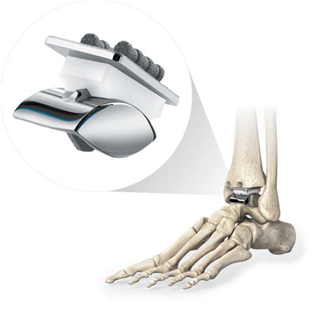 Star Total Ankle Replacement Stryker Ankle Replacement Bones Of
