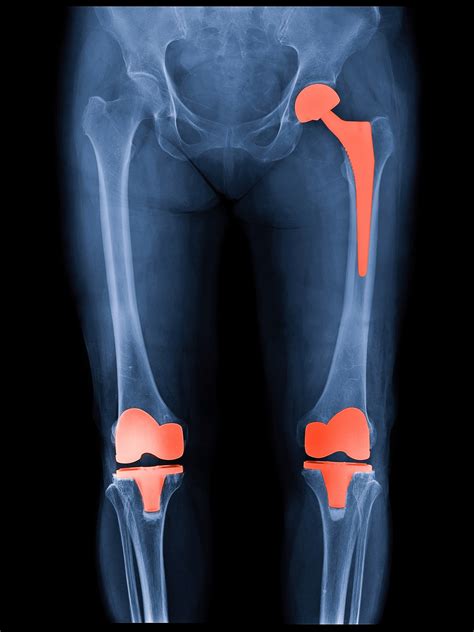 can you have a hip replacement under local anaesthetic orthopaedic hip and knee surgery