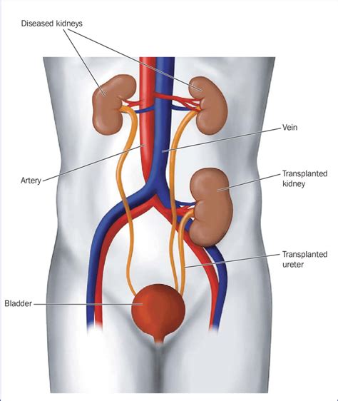 This is an inflammation of the kidney due to urinary tract infection. New Kidneys are located really high up. Interestingly ...