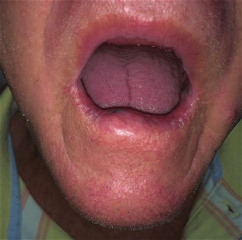 Lump In Lip That Comes And Goes