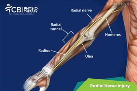 What Is Radial Nerve Injury Symptoms Causes Diagnosis