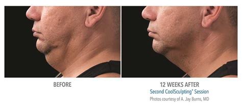 Reduce Under Chin Fat And Get Rid Of The Double Chin Our Treatments