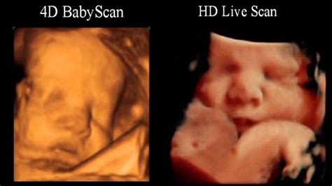 Baby Scanning 4d Scan Versus Hd Live Youtube