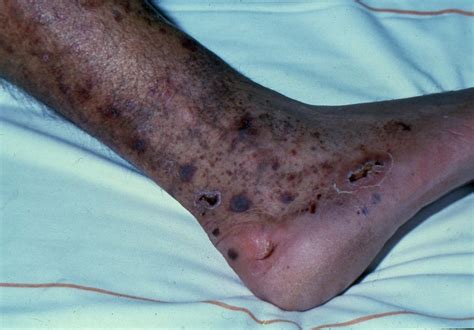Acd A Z Of Skin Leg Ulcers
