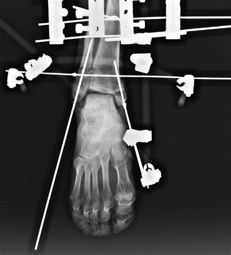 The Anteroposterior And Lateral Radiographs Were Taken After Fixation