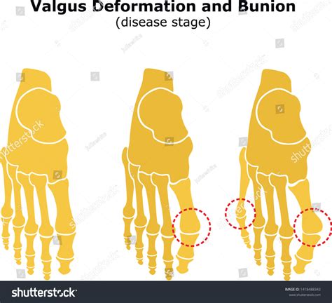 Age Valgus Deformity Thumb Bunion Stages Vetor Stock Livre De