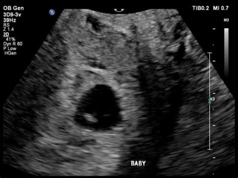 Transvaginal Ultrasound During Pregnancy 56 Off