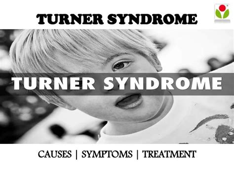 Ppt Turner Syndrome Causes Symptoms And Treatment Powerpoint