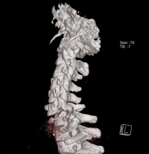 Bilateral Cervical Spine Facet Fracture Dislocation The Western