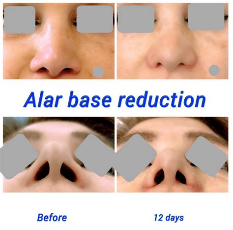 Alar Base Reduction Nostril Reduction Harley Clinic