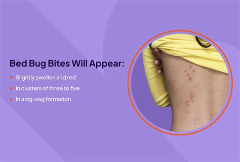 Bed Bug Bite Appearance Symptoms Treatment