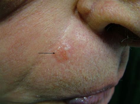 Basal Cell Carcinoma 10 Basal Cell Carcinoma Symptoms Vrogue Co