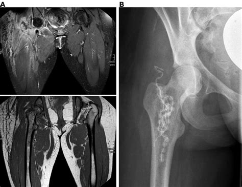 Pathological Fracture Of The Femoral Neck Following Septic Coxitis And