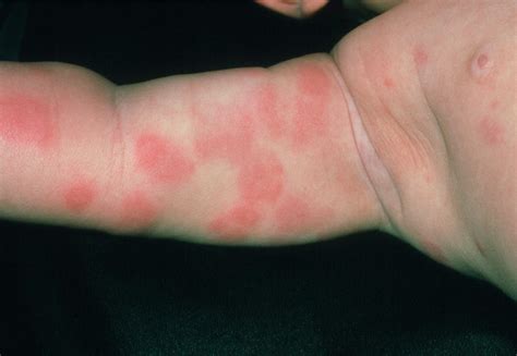 Baby Rash Pictures Causes Treatments Allergic Reactio