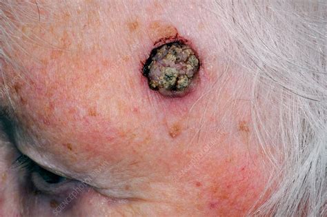 Basal Cell Skin Cancer On The Forehead Stock Image C0139691