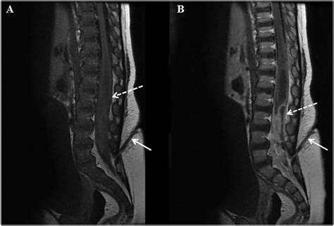 Spinal Abscess In A Patient With Undiagnosed Congenital Dermal Sinus