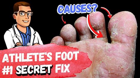 Best Athletes Foot Fungus Treatments Home Remedies 3 Big Secrets Youtube