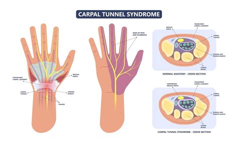 Carpal Tunnel Syndrome Causes And Treatment Medicofit