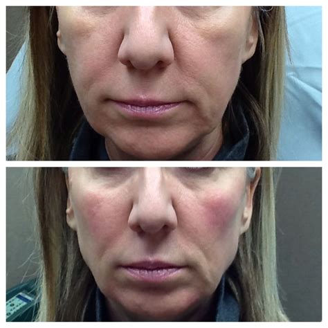 This Before And After Shows How A Little Filler In The Mid Upper Cheek Can Lift The Whole Face