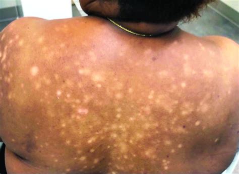 A 56 Year Old Black Woman Presented With Asymptomatic Hypopigmented