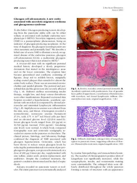 Pdf Glucagon Cell Adenomatosis A New Entity Associated With