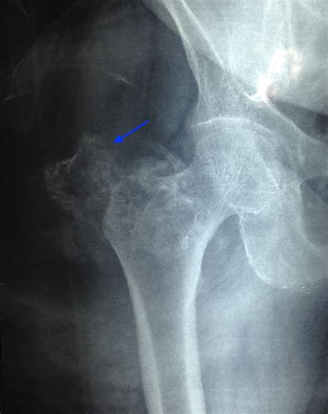 Cureus Giant Osteolipoma Fixed To The Greater Trochanter Of The Femur
