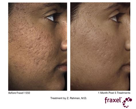 Fraxel Laser Before And After Dark Skin Change Comin