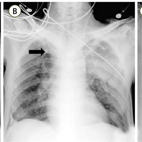 Malpositioned Tips Of The Central Venous Catheter Black Arrow Shown