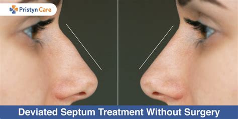 Signs You Have A Deviated Septum Infographic Ph