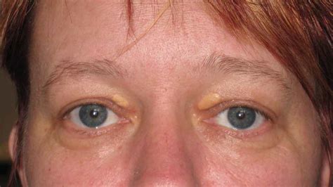 Xanthelasma Yellow Cholesterol Patches Around Eyes Treatment Mr